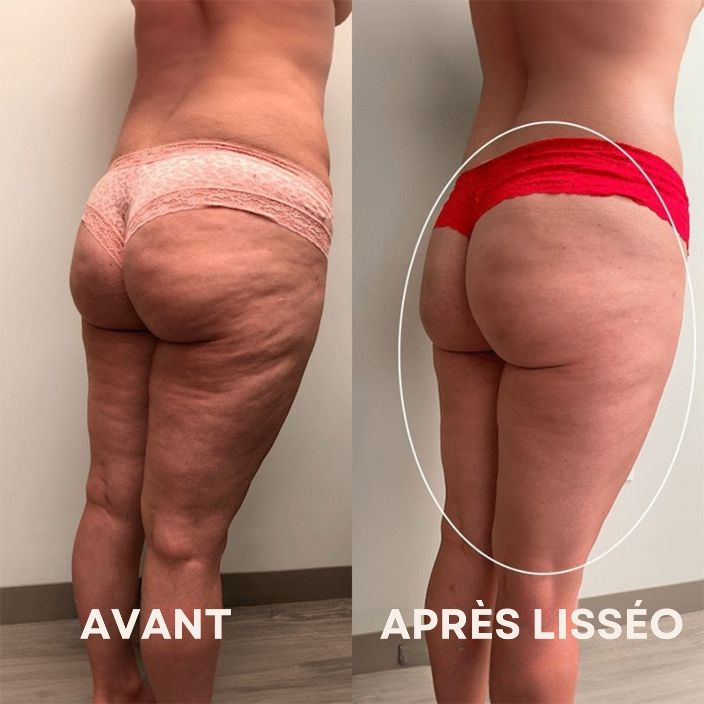 Lisséo - Appareil de Massage Anti-Cellulite